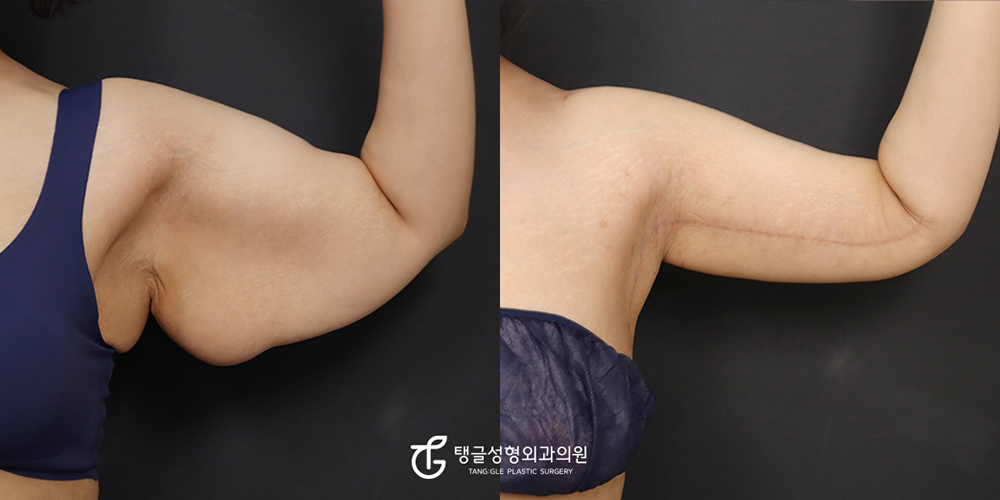 전체 팔거상+지방흡입 전후사진